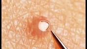 Infected Ingrown Hair On Leg