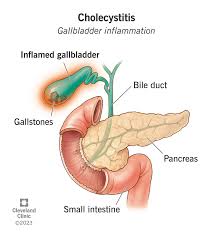 Medical illustration of cholecystitis: inflamed gallbladder with gallstones, bile duct, pancreas, and duodenum