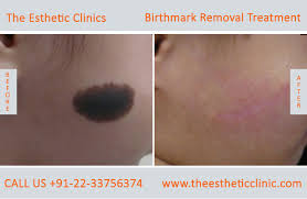Birthmark On Leg Meaning In Hindi Laser Birthmarks Treatment Mumbai Permanent Birthmark Removal Cost India The Esthetic Clinics