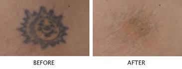 High intensity pulses of laser light target the pigment in the tattoo, while leaving the surrounding tissue intact. Laser Tattoo Removal Salmon Creek Plastic Surgery