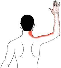 Thoracic Outlet Syndrome Treatment Oakville Exercises