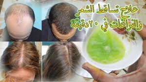 حل مشكلة تساقط الشعر الحل السحري لمنع تساقط الشعر حنين الذكريات