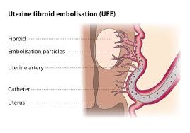 Uterine leiomyoma, also known as fibroids,a benign smooth muscle tumor of the uterus, light micrograph, photo under. Embolisation For Uterine Fibroids Cirse