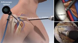 The reported incidence varies greatly, from 17% to 81% Pectoralis Minor Syndrome A Relatively Unknown Condition With A Somewhat Simple Solution Shoulder Elbow