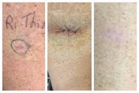 I Run For Wine Melanoma Update And What Melanoma Looks Like