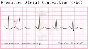 Pvc interpolated by the eccles health sciences library is licensed under the creative. How To Interpret Read Ekgs Like A Boss Master Heart Rhythms Education Nursejanx
