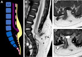 Image result for Spinal Dysraphism