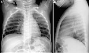 This illness can affect both children and adults. Pneumonia Pediatriavirtual Com