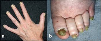 Image result for Yellow nail syndrome feet