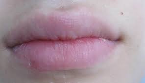 Ist Herpes Im Heilstadium Noch Ansteckend Gesundheit Sexualitat Haut