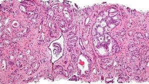 Resultado de imagen para Desarrollan ‘mini-estómagos’ productores de insulina para tratar la diabetes