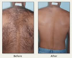 The male brazilian is referred to as a brozilian or mankini. Laser Hair Removal For Men And Women Of All Shades Of Color Dr Dean Kane