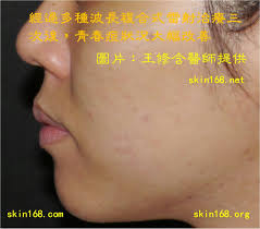 皮膚科王修含醫師: 青春痘的雷射光電治療