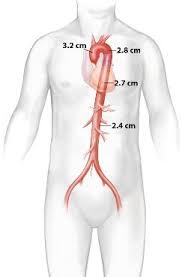 Aortic Aneurysms Lemaitre Vascular