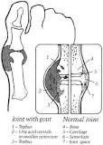 Image result for how to break down uric acid crystals topical treatment