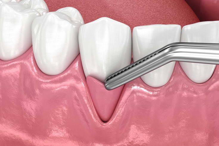 Gum & Flap Surgery product image