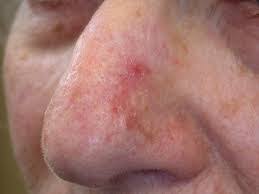 It looks like a curvature to the side. Protect Your Nose It S Vulnerable To Skin Cancer