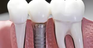 Is Dental Implant Covered by Insurance? - Vitrin Clinic