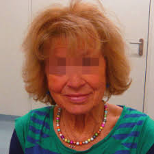 Tiefe Hirnstimulation Hi