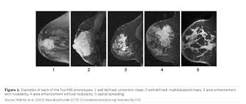 Dcis on mri may create an area of irregular enhancement of the mri dye into the breast. Neoadjuvant Chemotherapy For Breast Cancer Unanswered Questions Healthmanagement Org