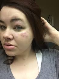 Bed bugs at Econo Lodge