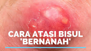 Banyak bekas luka yang sering mengganggu pemandangan, salah satunya bekas luka bisul. Bisul Punca Dan Cara Rawatan Cepat Dan Berkesan Youtube