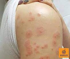 Mereka boleh menguruskan tanpa makanan selama beberapa bulan. E Kill Bedbugs Tanda Tanda Gigitan Bed Bugs 1 Adakah Facebook