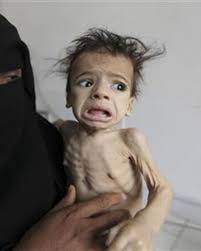Million Yemen children face severe malnutrition