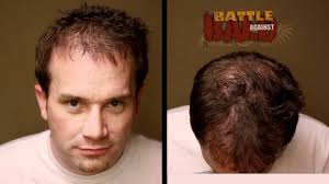 I dont have exact figures but places vary by location, waiting times/short notice bookings and more importantly by the technique used: Hair Transplant Results 12 Month Time Lapse Before And After Bosley Medical Youtube
