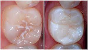 Check spelling or type a new query. Dental Sealants