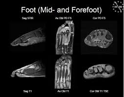 A magnetic resonance imaging (mri) was performed on a normal subject; Ankle Foot Mri