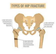 Image result for Fracture