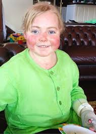Girl, 17, has painful condition which makes her skin as delicate as a  butterfly's