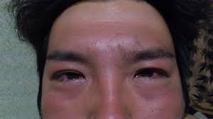 溶接 目 を 焼く