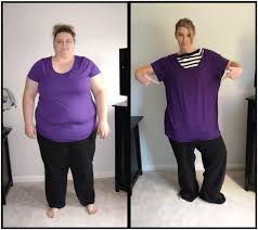 The total gastric sleeve cost starts at around $3,500 but can be as high as $20,000+ depending whether or not your insurance covers it, your for example, the average cost of gastric sleeve in the united states is $19,190. Gastric Bypass Before And After Pictures How Life Will Change Bariatric Surgery Source