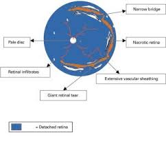 Retinal Drawing At Getdrawings Com Free For Personal Use