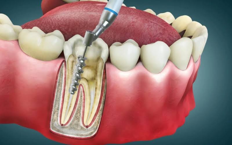 Root Canal Treatment (RCT) in Siliguri product image