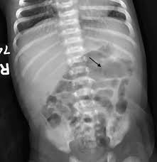 Image result for Necrotizing Enterocolitis