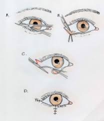 Image result for Eyelid Closure Defect