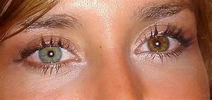It may be inherited, or caused by genetic mosaicism, chimerism, disease, or injury. Centralis Heterochromia What Is Heterochromia The Term Heterochromia Usually Refers To The