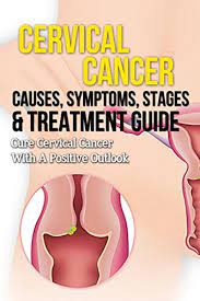 500,000 new cases are diagnosed each year worldwide. Cervical Cancer Causes Symptoms Stages Treatment Guide Cure Cervical Cancer With A Positive Outlook Kindle Edition By Dixon Danielle Professional Technical Kindle Ebooks Amazon Com