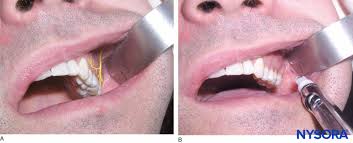 Image result for Periapical Block