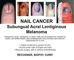Image result for Acral lentiginous melanoma nail