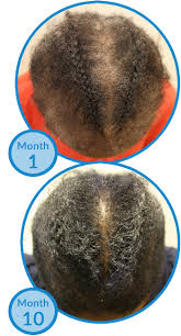 However, natural products have been shown to accelerate hair regrowth, such as black sesame oil. Ccca Hair Loss In Black Women Linked To Uterine Fibroids