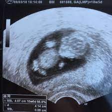 Wird Es Ein Junge Ooder Ein Madchen Schwangerschaft Schwanger Baby