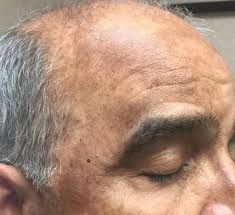 Image result for Melasma
