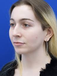 Soften Nasal Contour 6039