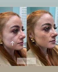 Medial cheek filler for this beauty ✨🥰 #cheekfiller #filler #inject  #injectables #injector #medspa #beauty #utah