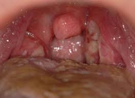 Image result for Primary Syphilis