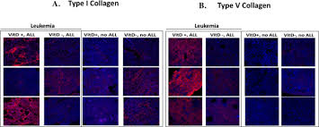 Myeloid leukemia or myelogenous leukemia is a type of cancer that occurs in red blood cells and these types of leukemia may further have more subcategories, but the main types are as follows Role Of Vitamins A And D In Bcr Abl Arf Acute Lymphoblastic Leukemia Scientific Reports